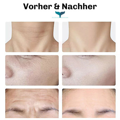 EMS Facelifting Gerät LumiFace
